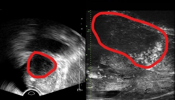 [서울=뉴시스] 기존 전립선 초음파 사진(좌) 및 최신 초음파 사진. 기존 초음파는 전립선 부위(동그라미 친 부분)의 음영 차이로만 병변을 확인했지만, 마이크로 초음파는 높은 해상도를 통해 종양과 주변 조직의 모양까지 확인할 수 있다. (사진= 분당서울대병원 제공)
